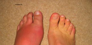 Bệnh Gout là gì? Cách phòng tránh bệnh Gout