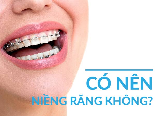 Có nên niềng răng hay không?