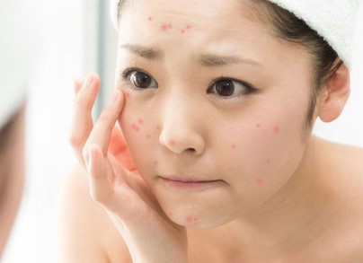 Nhìn vào giấc mơ thấy mụn mọc ở trán