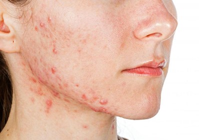 Ý nghĩa từ giấc mơ thấy mụn mang đến