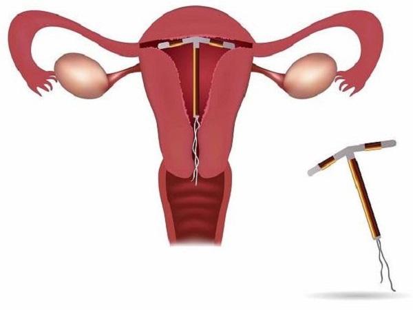 Đặt vòng tránh thai là gì?