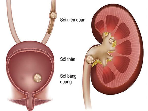 Giải đáp chi tiết sỏi thận kích thước bao nhiêu phải mổ