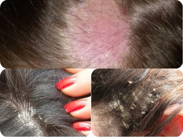 Ngứa da đầu và rụng tóc là bệnh gì nguyên nhân cách điều trị